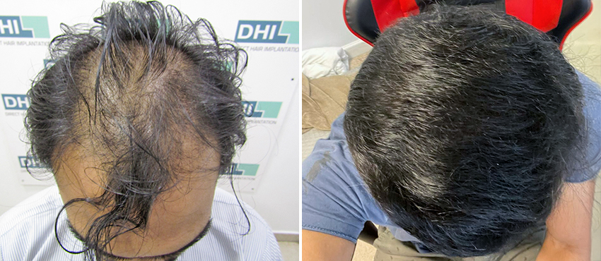 DHI before & after hair transplant results